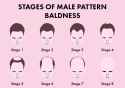 Stages-of-Bald-1-e1614688573620.jpg